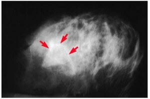 Mammogram. Arrows show abnormal calcifications in the breast tissue.