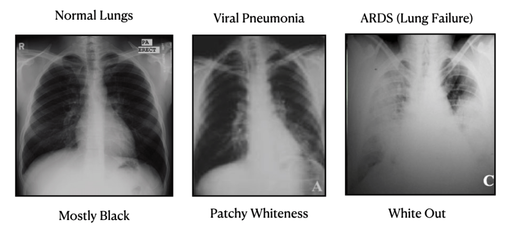 Comparing Viral Pneumonia ARDS and Normal Lungs