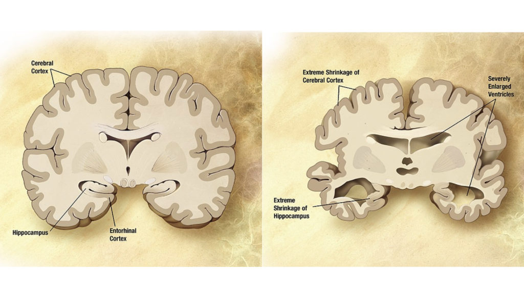 Alzheimers versus normal brain