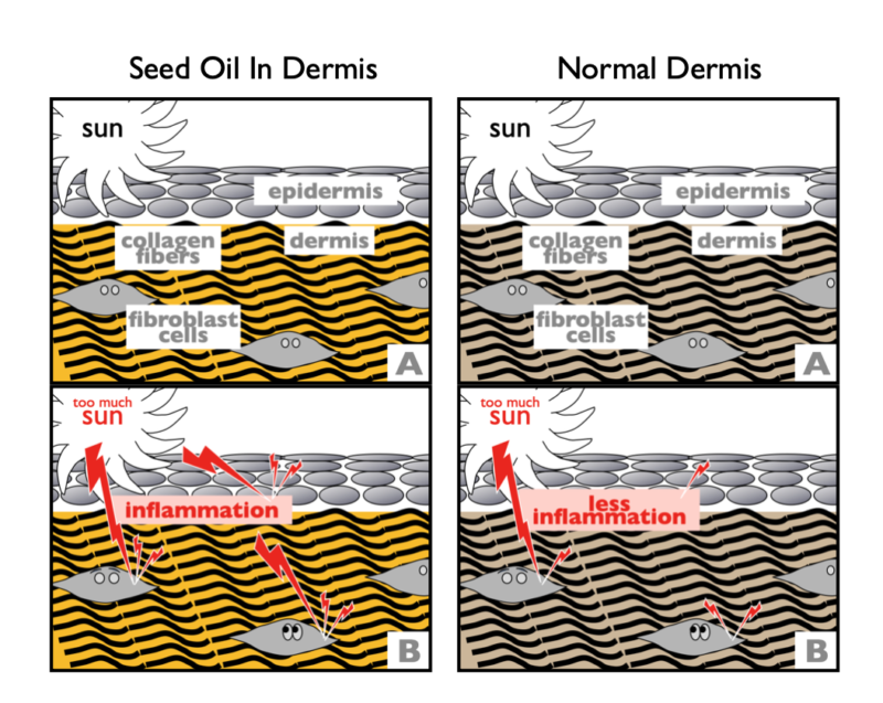 seed oils under your skin magnify the inflammatory effect of UV
