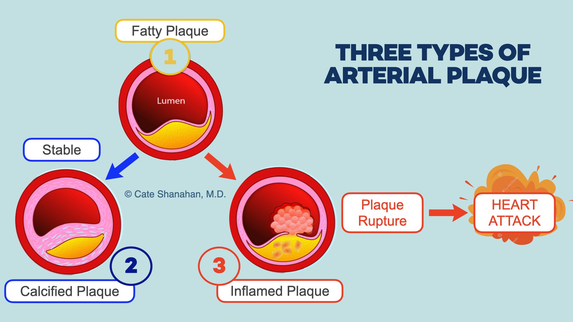 The Truth About Coronary Calcium Tests - Dr. Cate